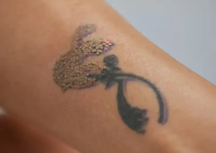 Tatoeageverwijdering